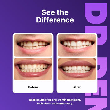 Purple Teeth Whitening Strips